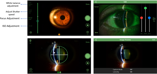 Four smartphone app screenshots: a captured iris and anterior eye with on-screen controls for white balance, shutter speed, focus and ISO; an edit view with color sliders; a centring reticle over the eye; and an image-preview screen showing capture mode and laterality