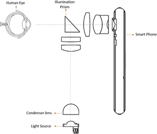Exploded optical diagram of a smartphone slit lamp: from the bottom, a light source and condenser lens send a beam up through an illumination prism and lenses into the human eye, while a smartphone alongside captures the image